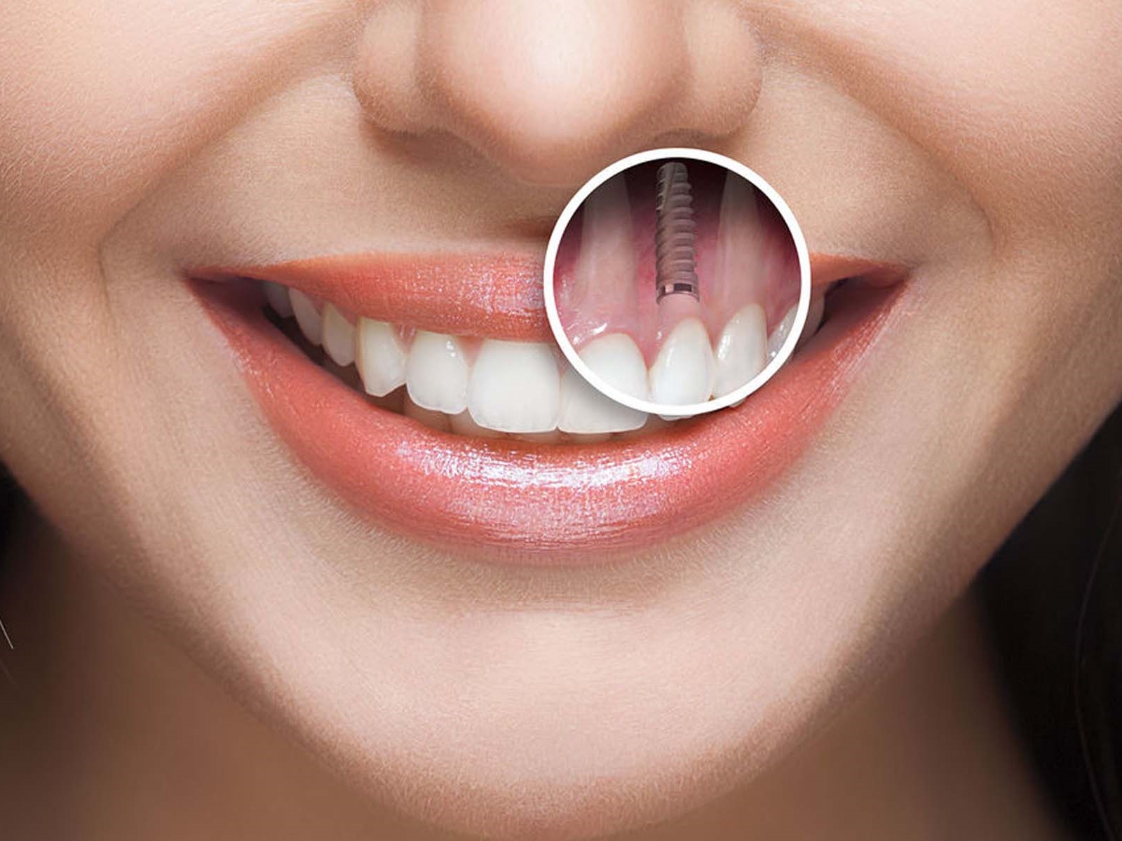 mất răng lâu năm - hình 3