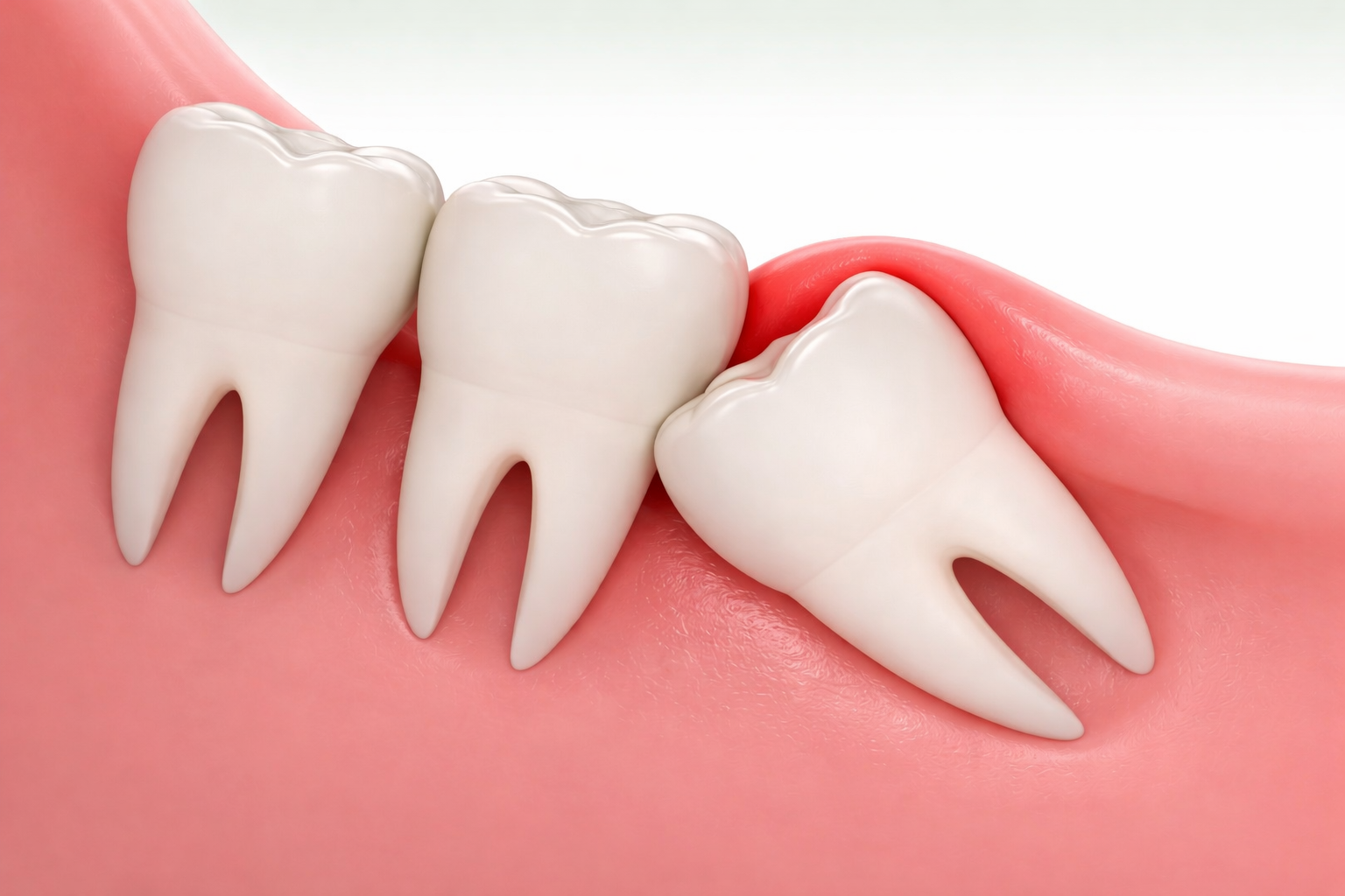 nhổ răng khôn - hình 2