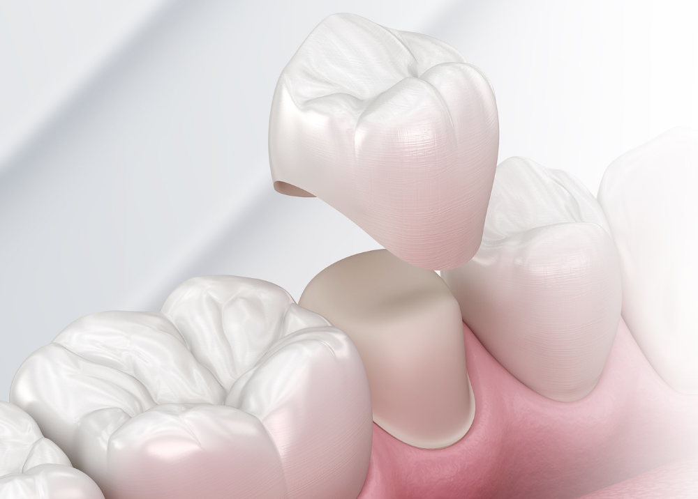 Răng sứ thẩm mỹ: 7 dòng sứ tốt nhất và bảng giá chi tiết 2026