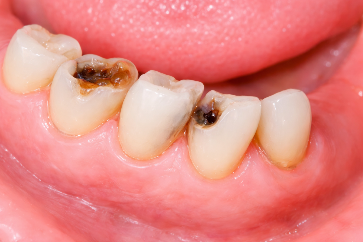 Sâu răng: 6 nguyên nhân và 3 cách điều trị hiệu quả nhất 2026