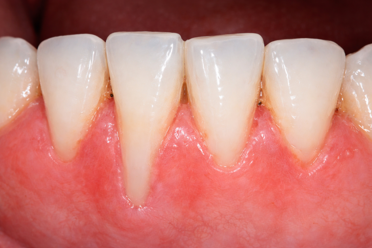 viêm nướu - hình 4