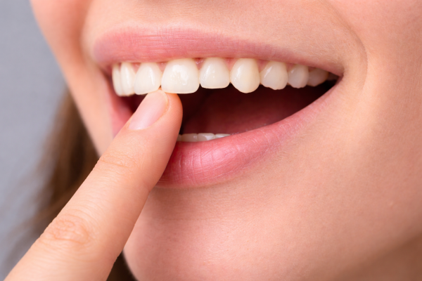 Lấy cao răng định kỳ: 5 lý do bạn không thể bỏ qua 2026