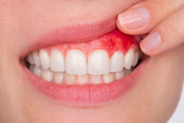 Viêm nướu: Dấu hiệu cảnh báo sớm mà 80% người Việt bỏ qua