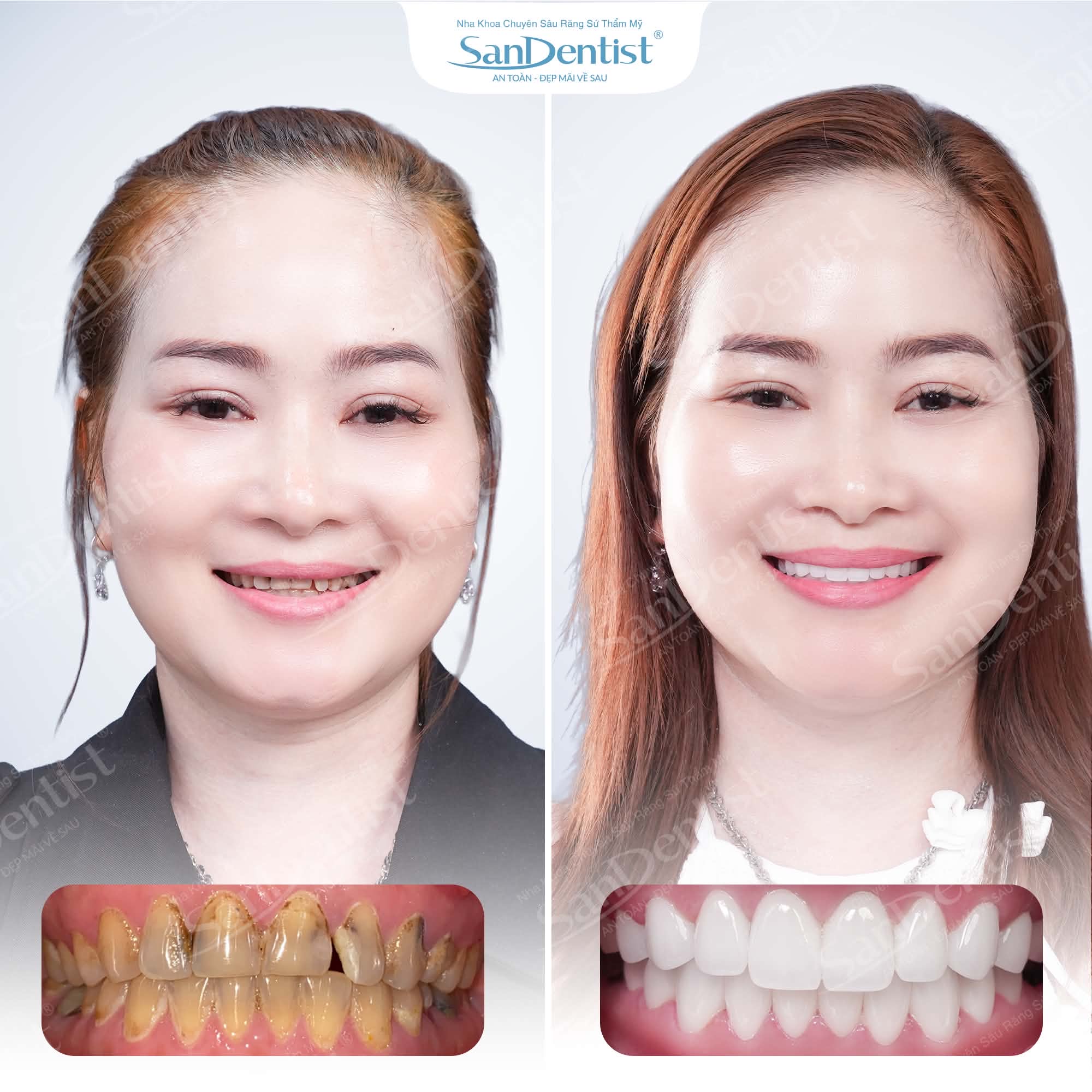 Khách hàng phủ răng sứ thẩm mỹ tại San Dentist – trước và sau
