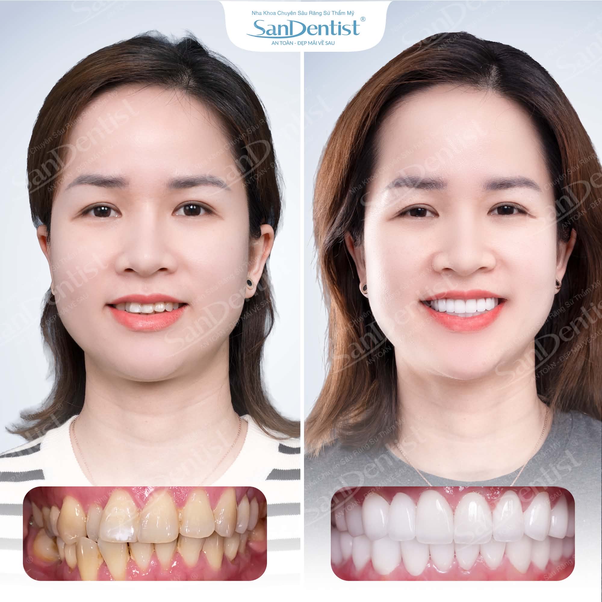 Khách hàng phủ răng sứ thẩm mỹ tại San Dentist – trước và sau
