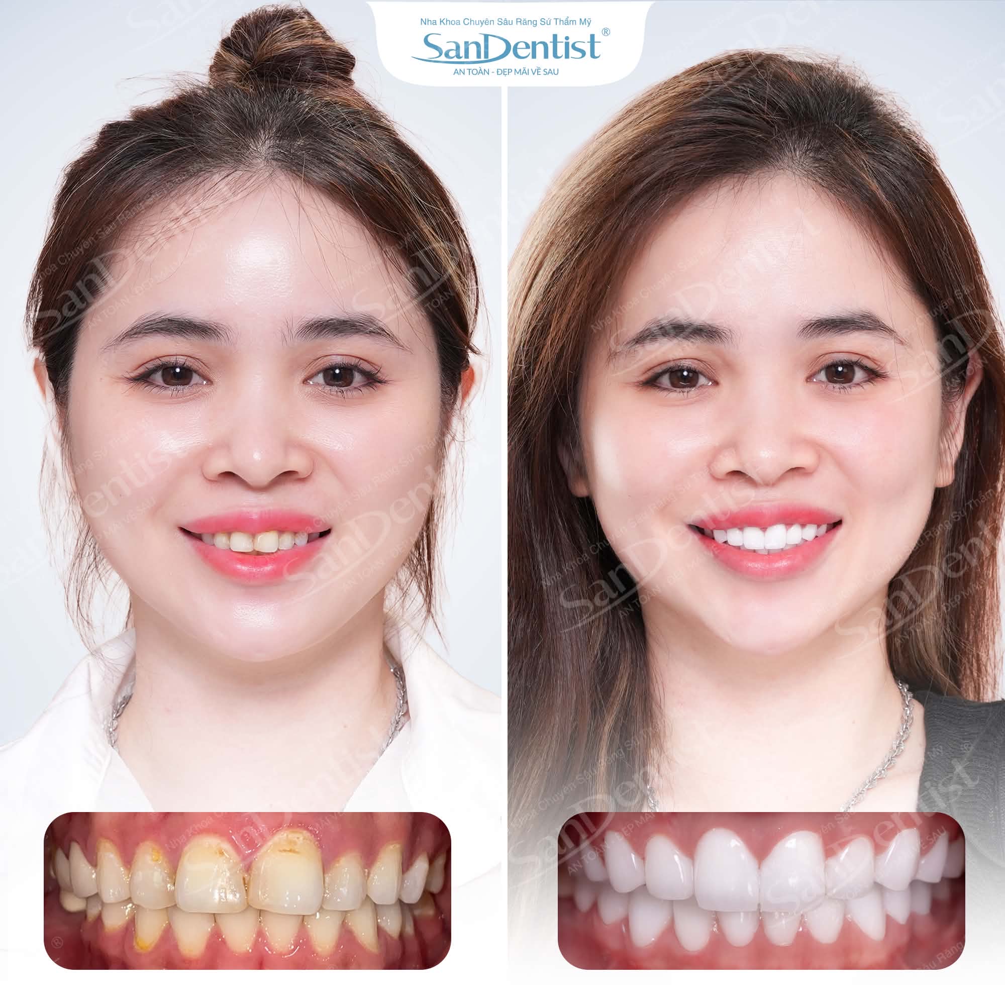 Khách hàng phủ răng sứ thẩm mỹ tại San Dentist – trước và sau