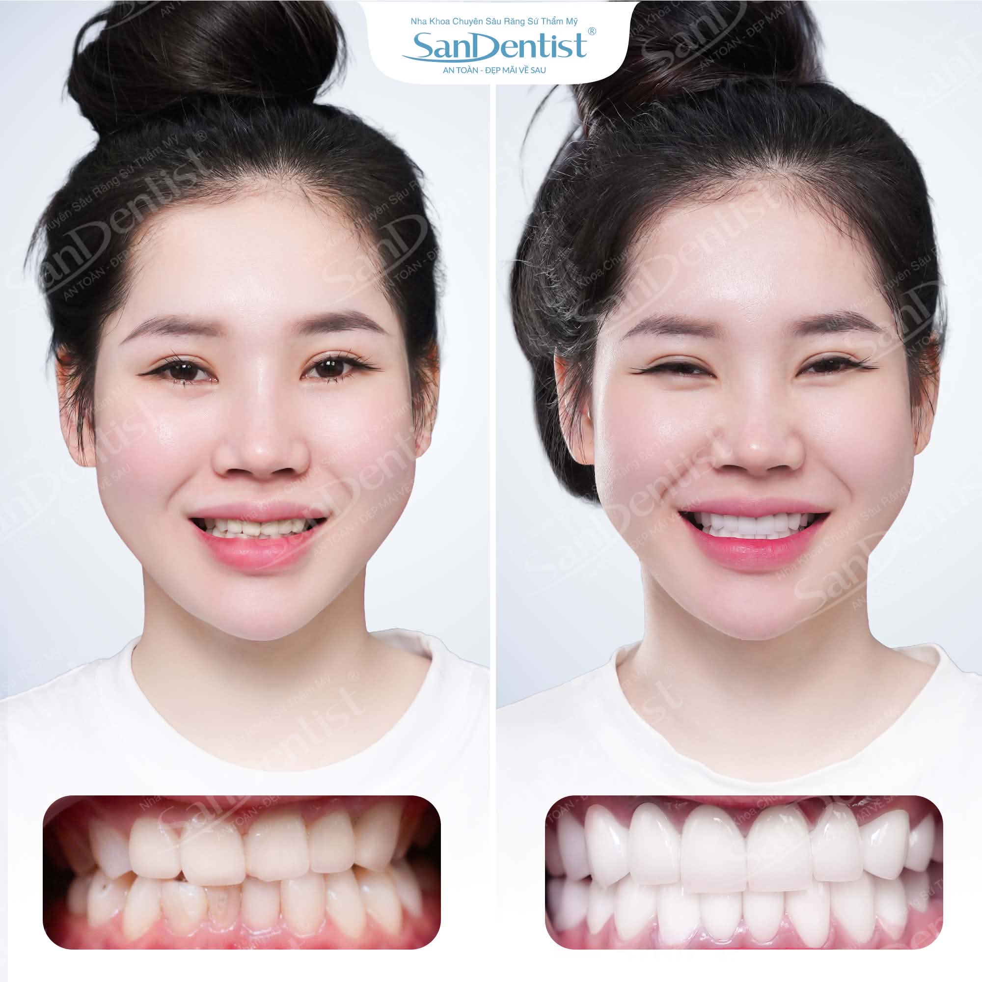 Khách hàng phủ răng sứ thẩm mỹ tại San Dentist – trước và sau