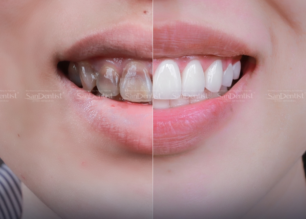 bọc răng sứ nacera - hình 2