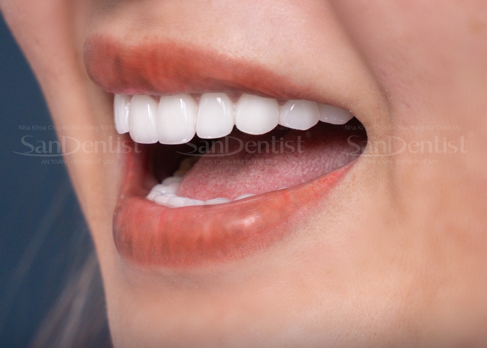 bọc răng sứ nacera - hình 3