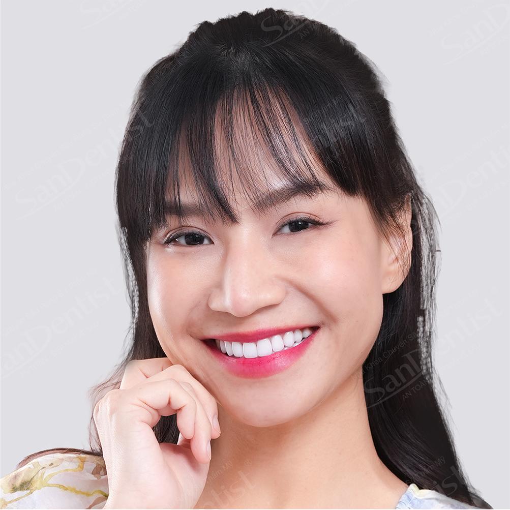 dán sứ veneer không mài - hình 4