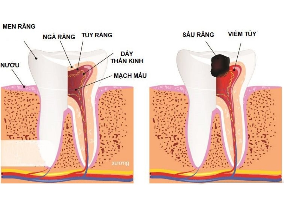điều trị tủy răng tphcm - hình 3