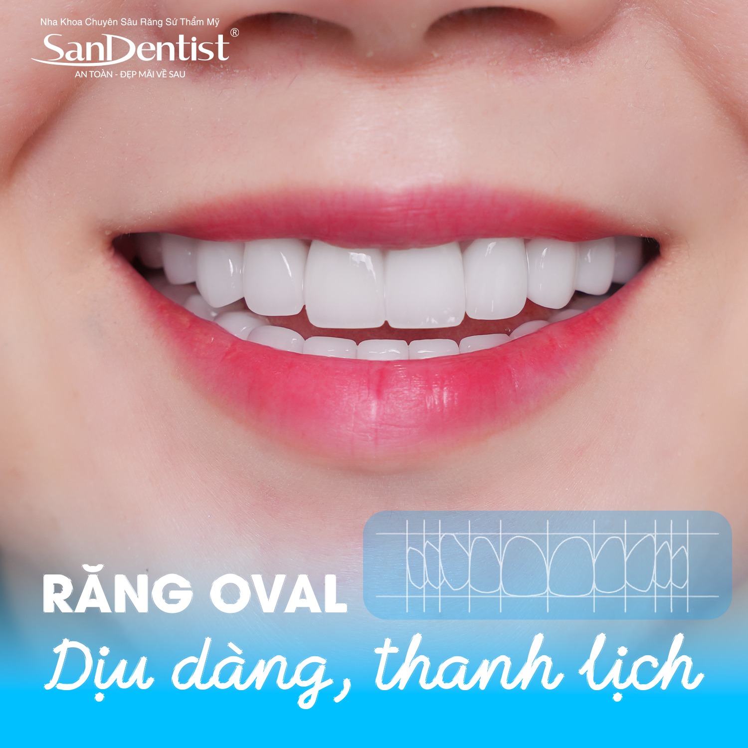 Răng oval – Dịu dàng, thanh lịch