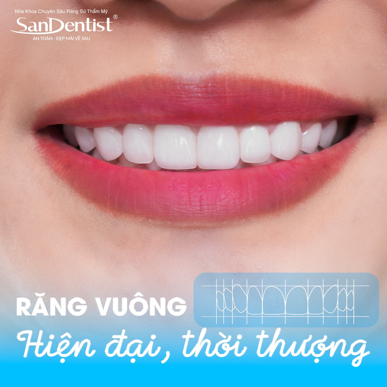 Răng vuông – Hiện đại, thời thượng