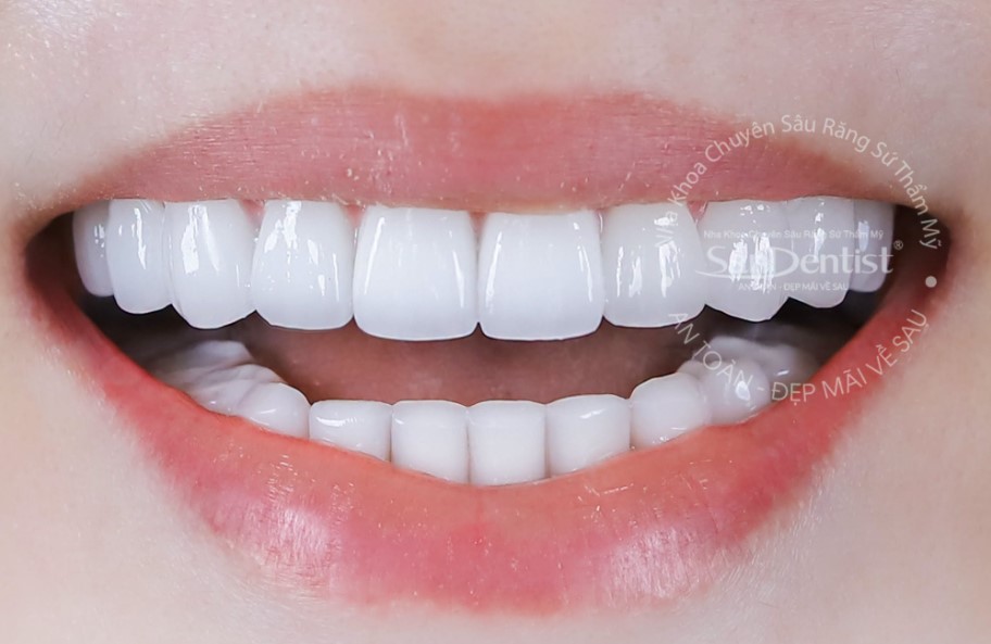 Combo 16 răng sứ Orodent Bleach trọn đời 2026