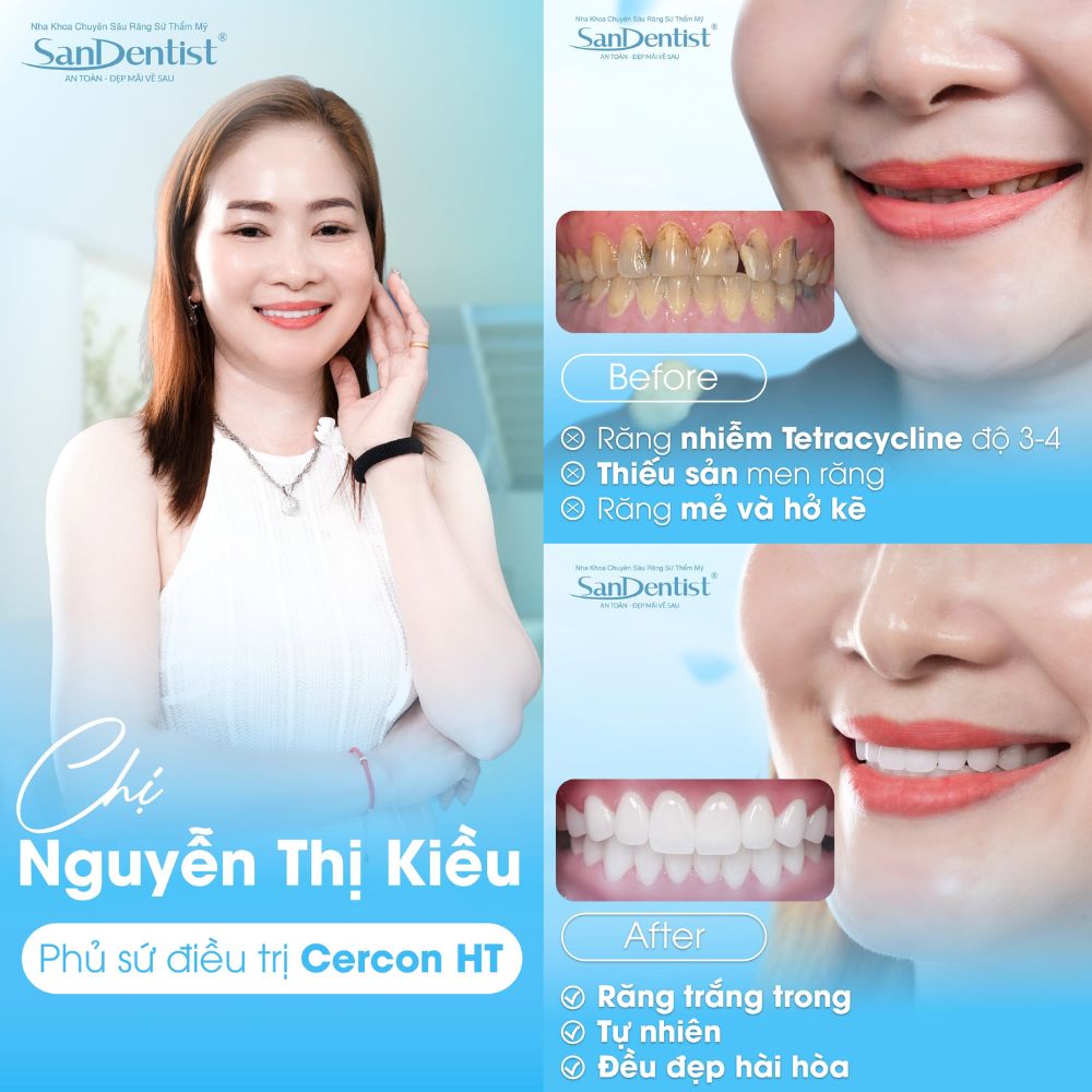 bọc răng sứ răng cửa