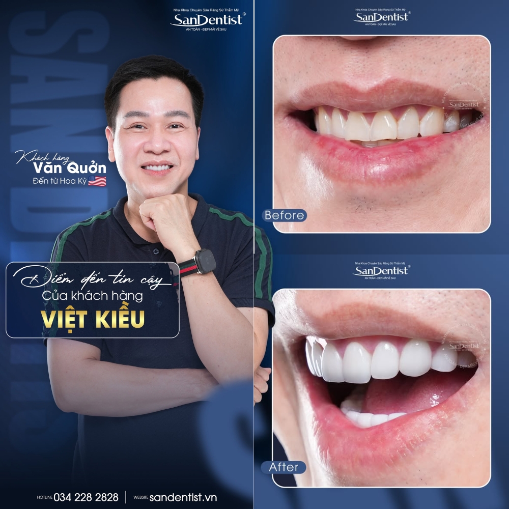 dán veneer không mài tphcm - hình 2