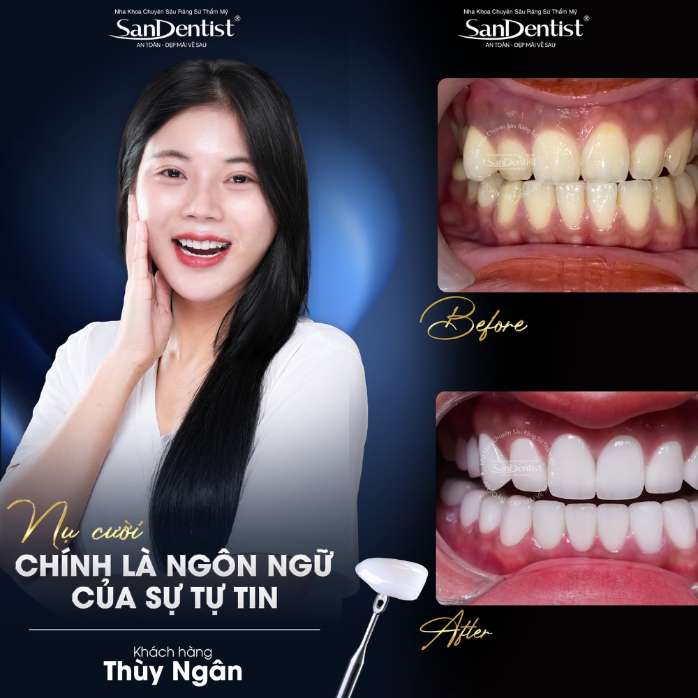 dán veneer không mài tphcm - hình 5