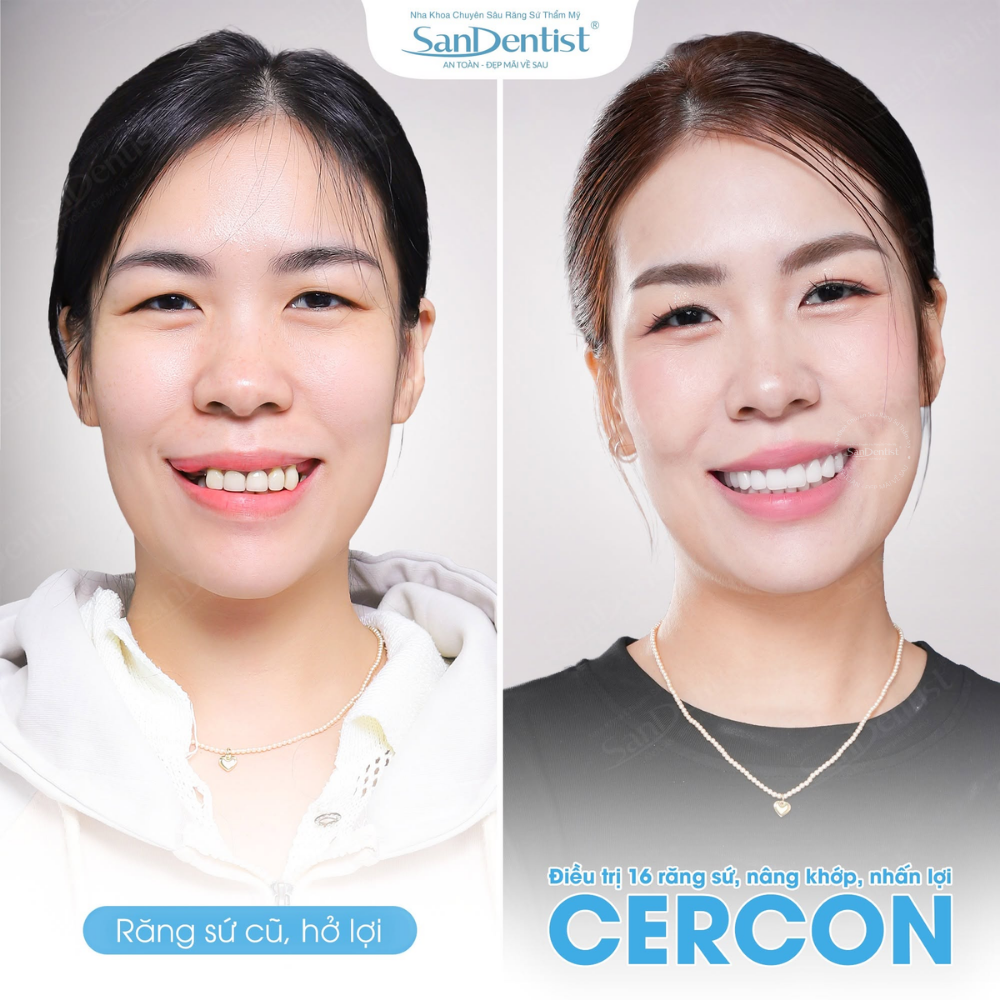 răng sứ cercon ht - hình 3