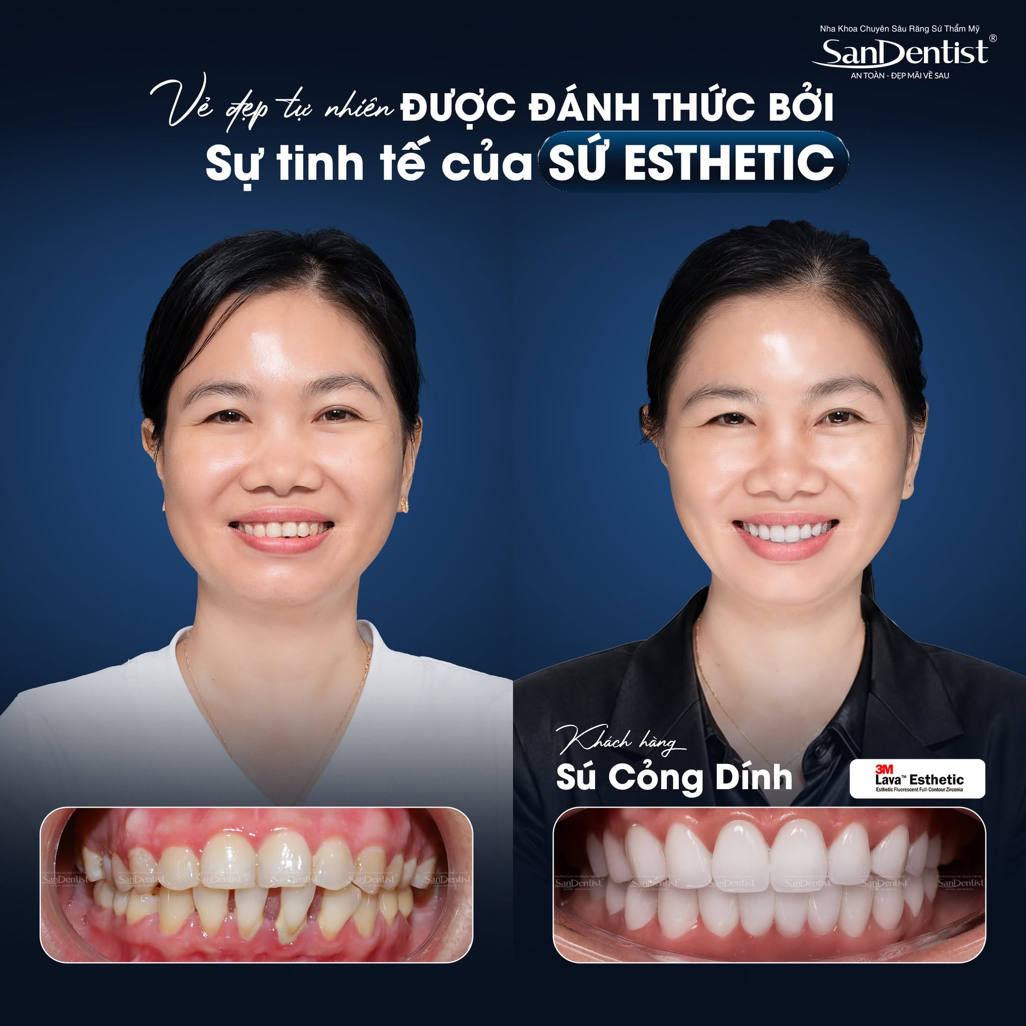 răng sứ lava 3m