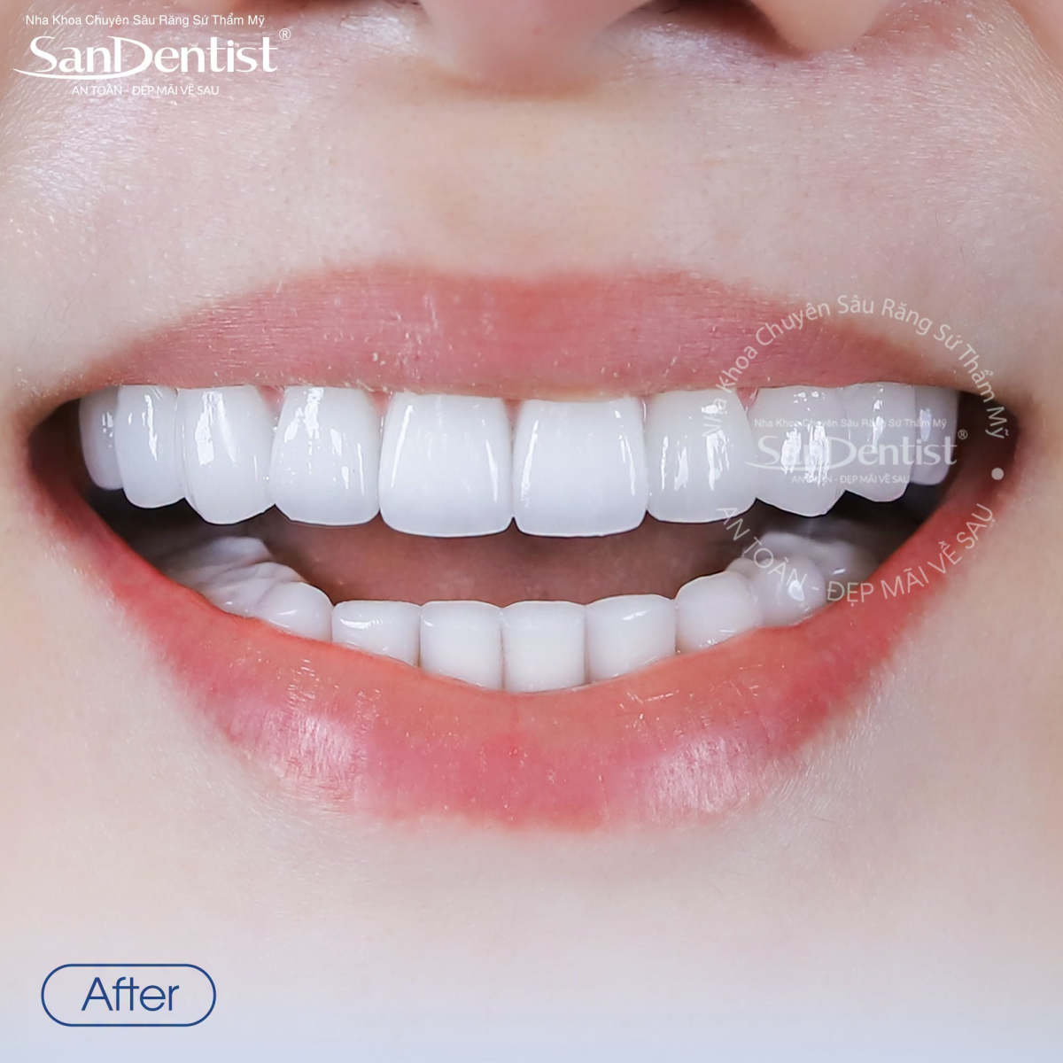 Răng sứ Lava 3M Esthetic: 15 năm bảo hành 2026