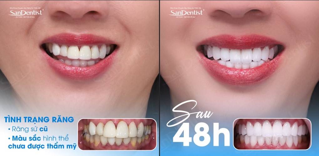 răng sứ lava 3m - hình 4
