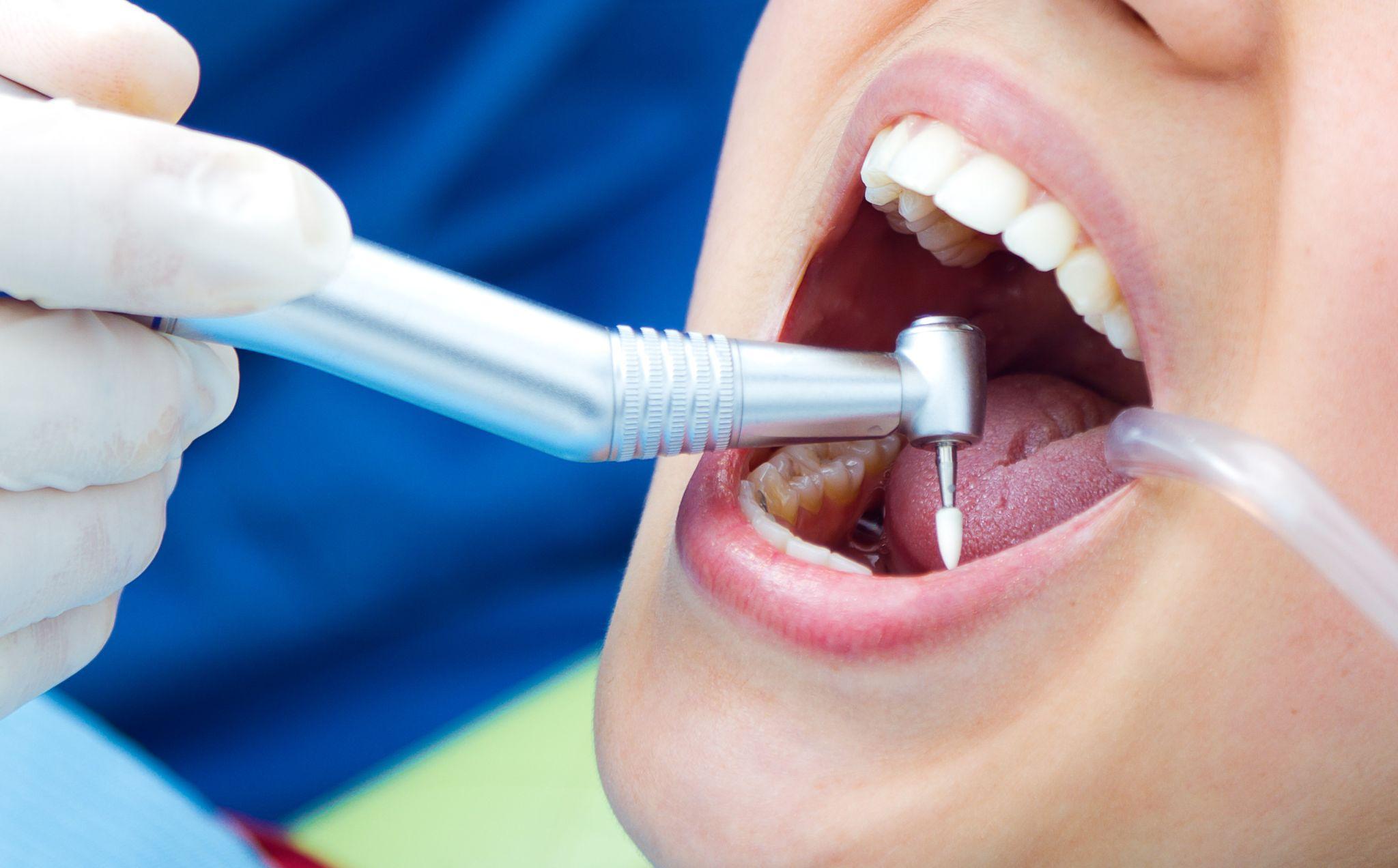 trám răng thẩm mỹ tphcm
