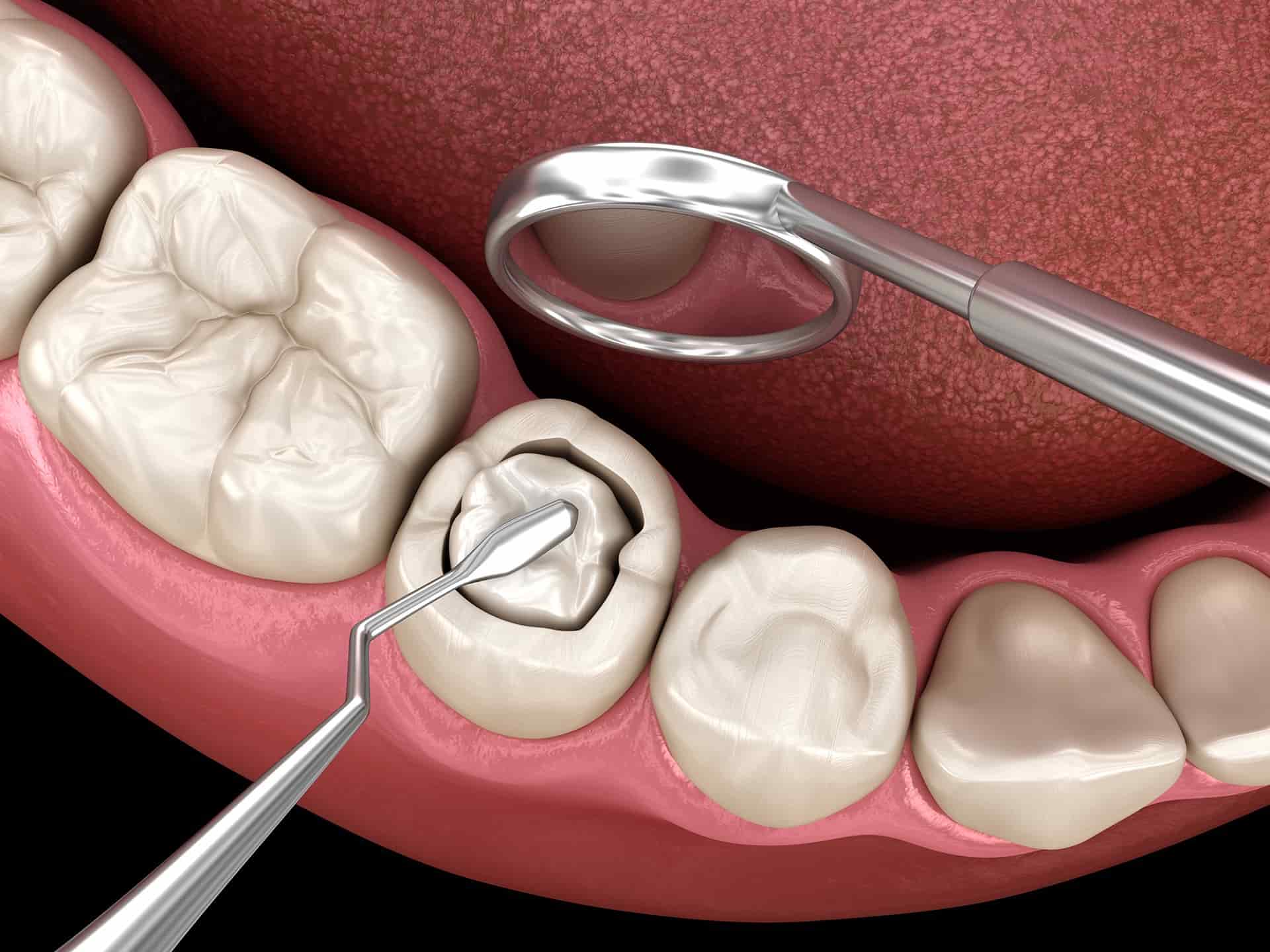 trám răng thẩm mỹ tphcm - hình 2