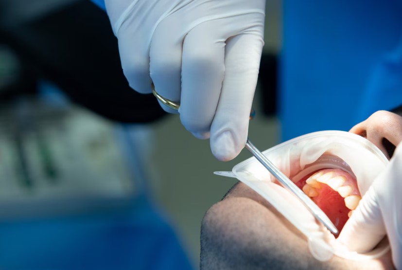 trám răng thẩm mỹ tphcm - hình 6