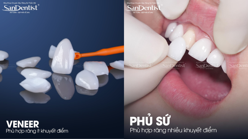 Veneer vs bọc răng sứ: chọn nào bảo tồn răng 2026