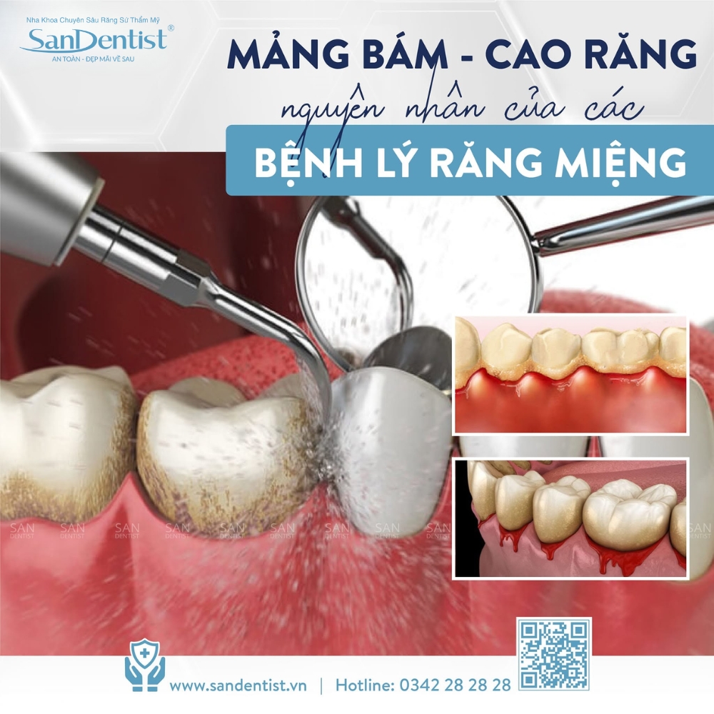 lấy cao răng có tốt - hình 3