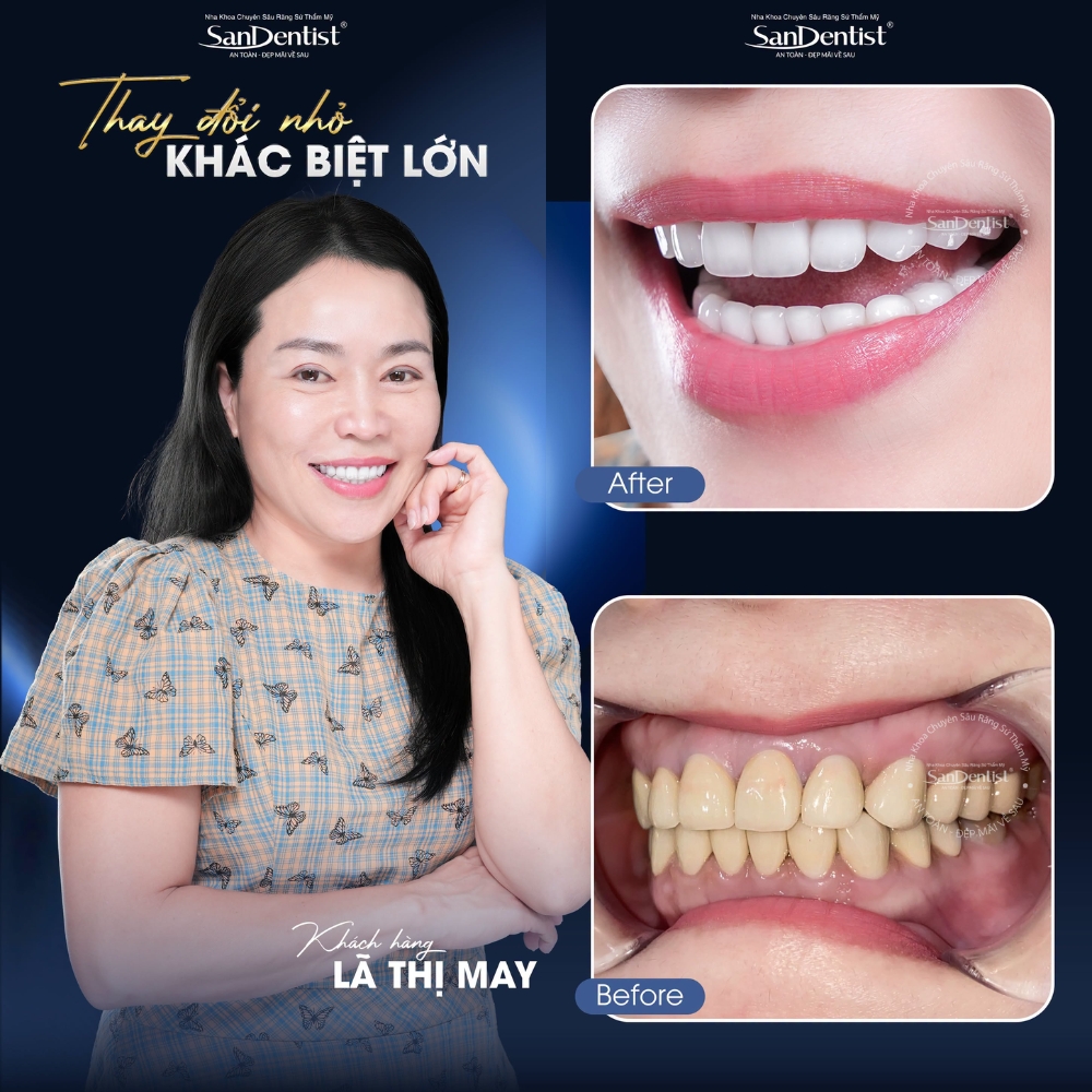Quy trình bọc răng sứ chi tiết 2026