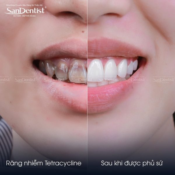 Răng đổi màu tetracycline: tẩy được không 2026