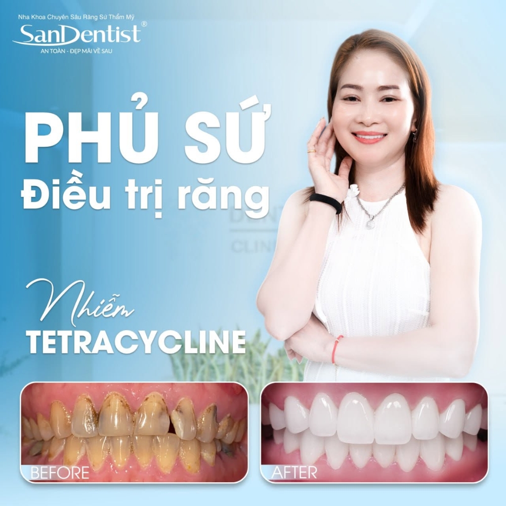 răng đổi màu tetracycline - hình 2