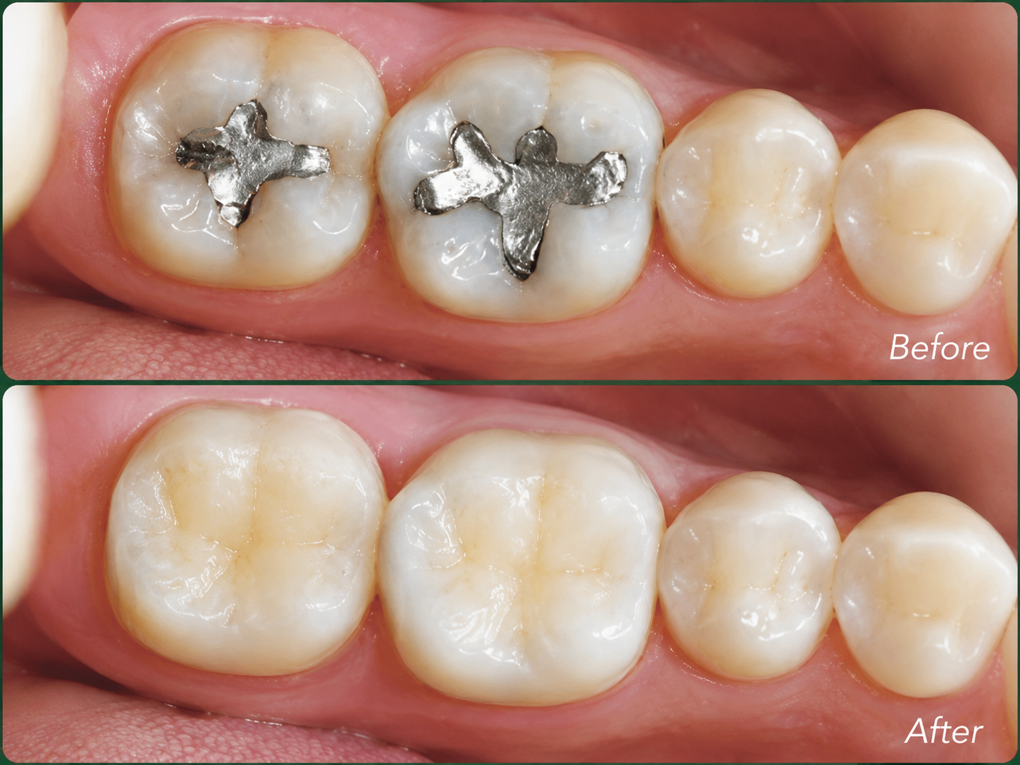 thay trám amalgam composite - hình 2