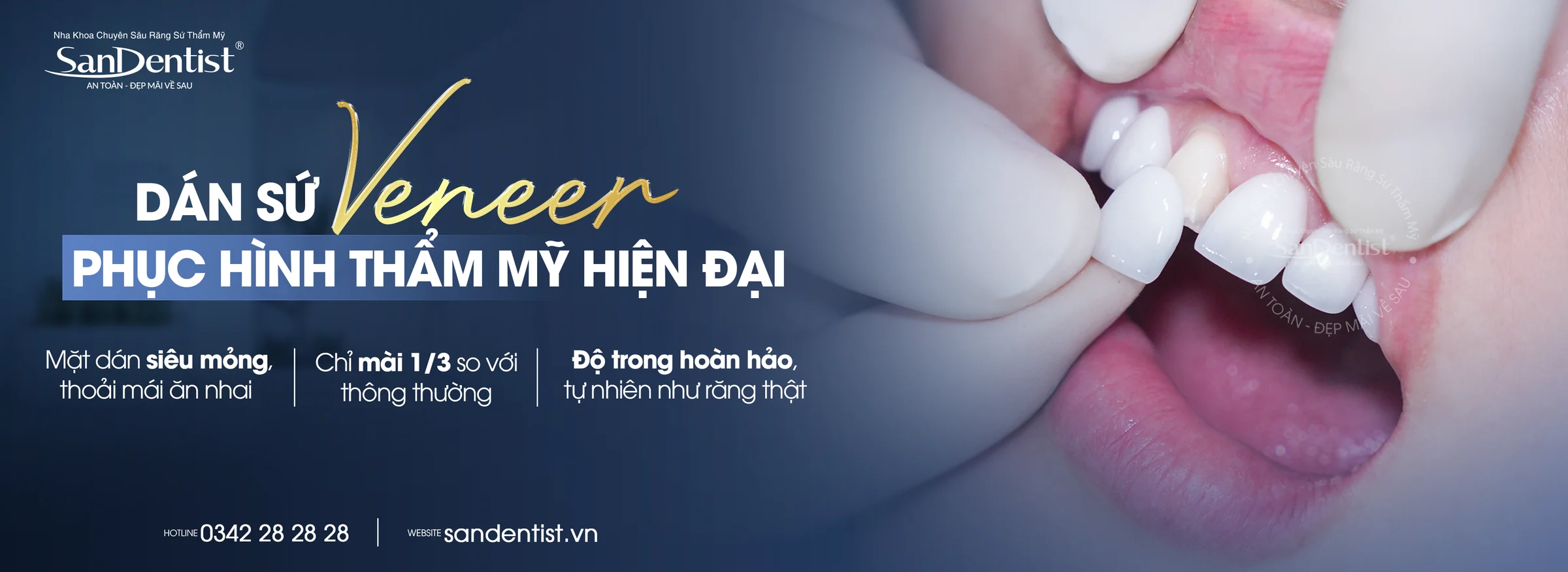 Dán sứ Veneer - phục hình thẩm mỹ hiện đại tại San Dentist
