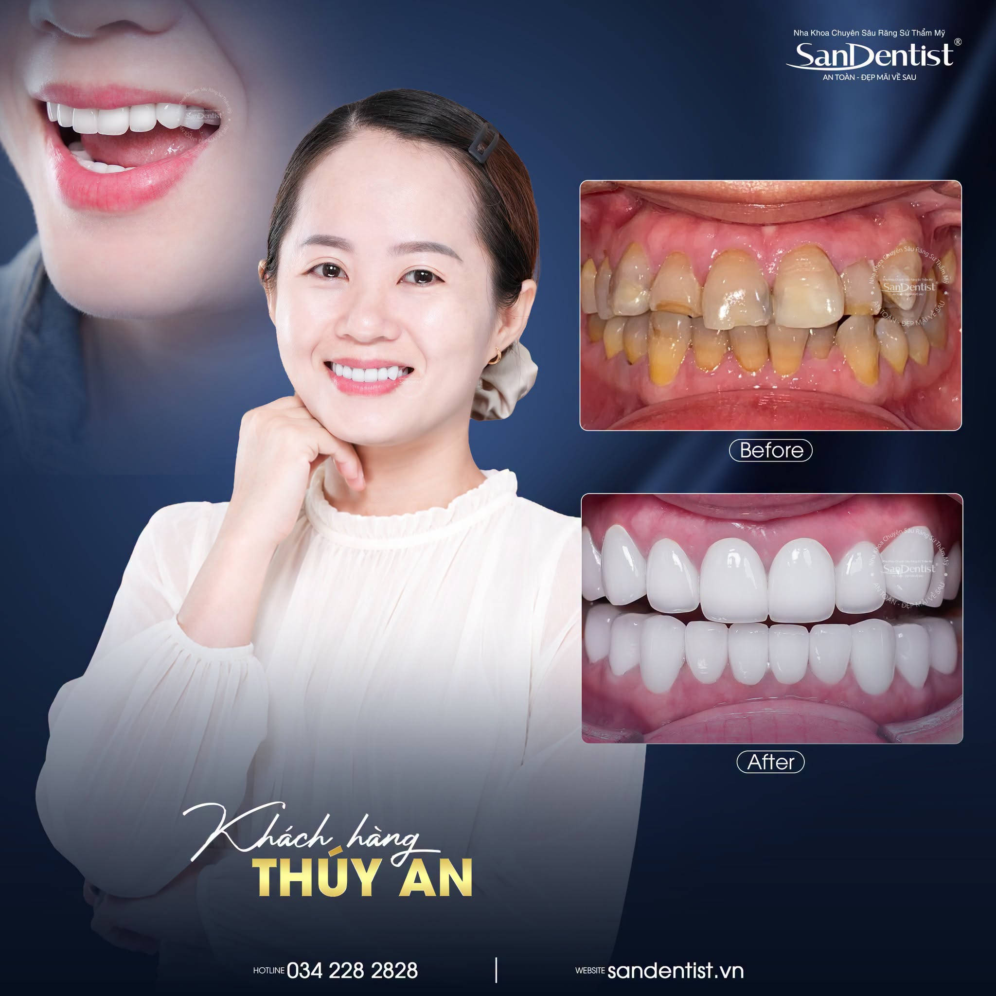 combo 16 răng sứ giá