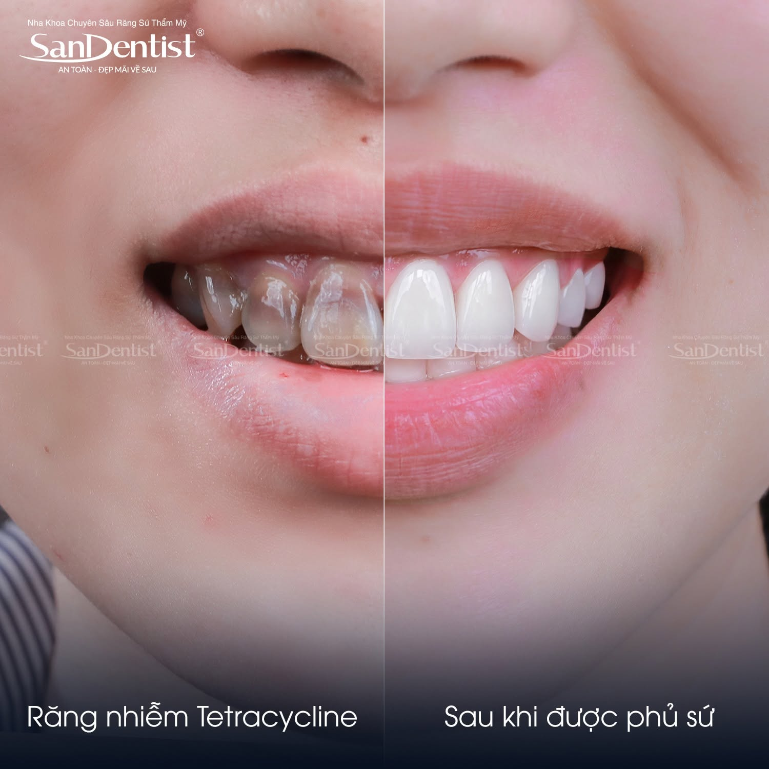 combo 16 răng sứ giá - hình 2