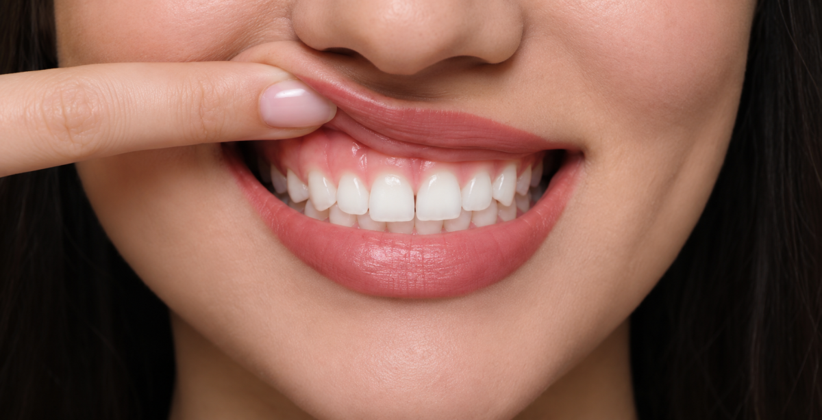 Cười hở lợi là gì: nguyên nhân & điều trị 2026