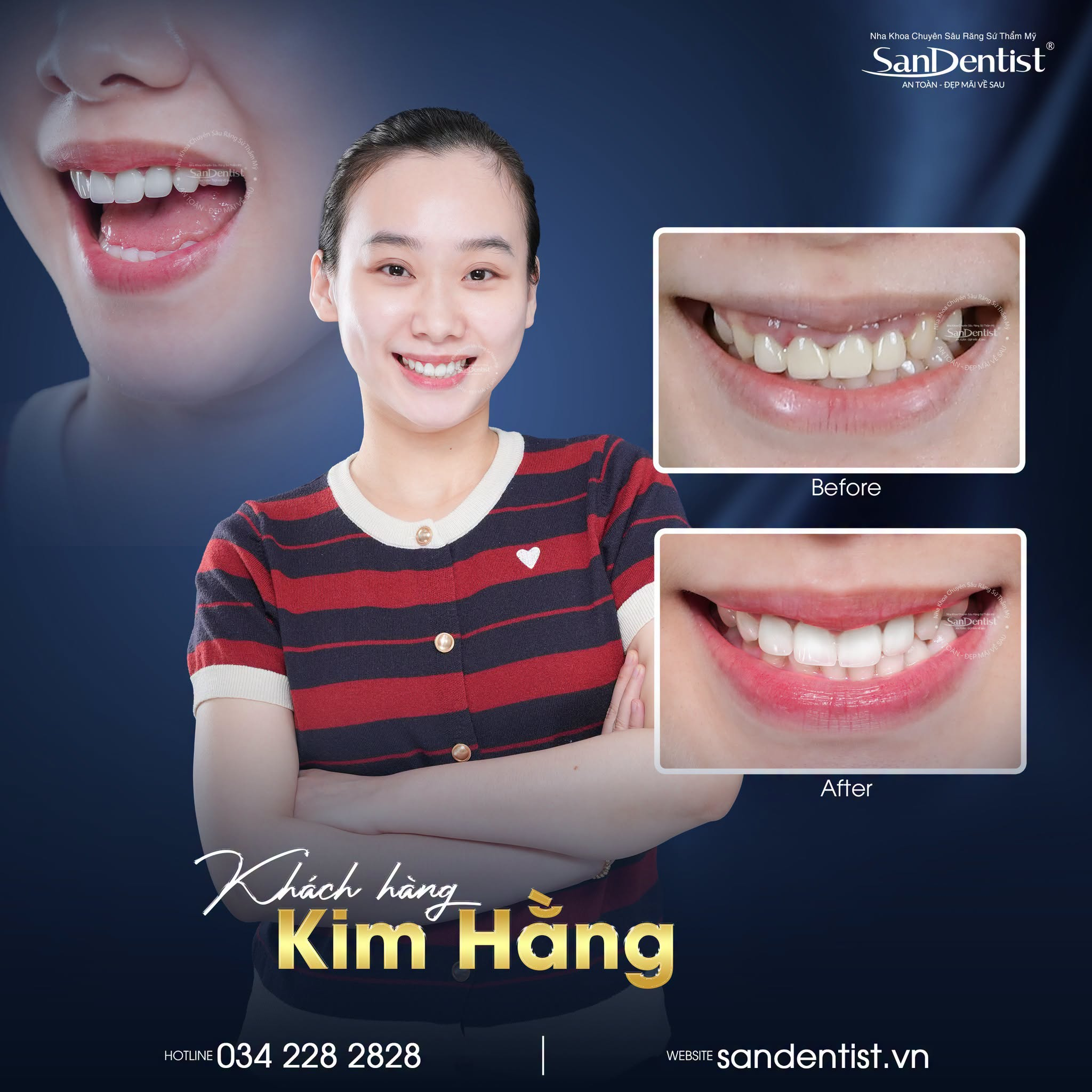 cười hở lợi là gì - hình 3