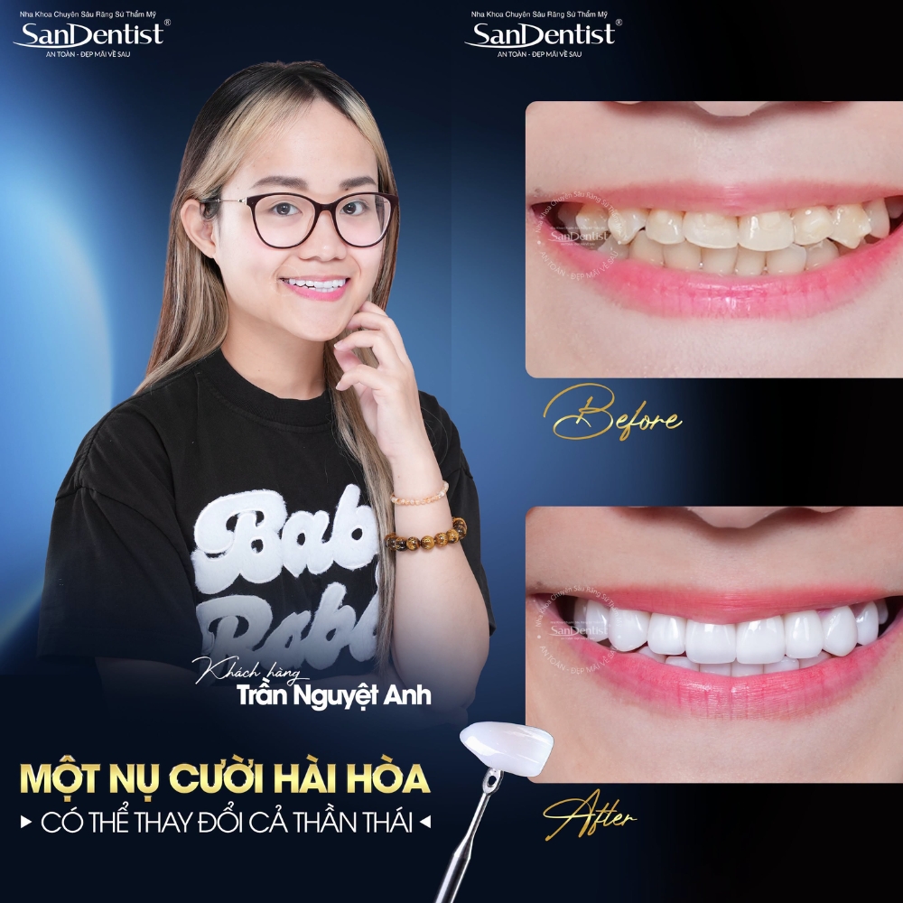 dán sứ veneer là gì - hình 2