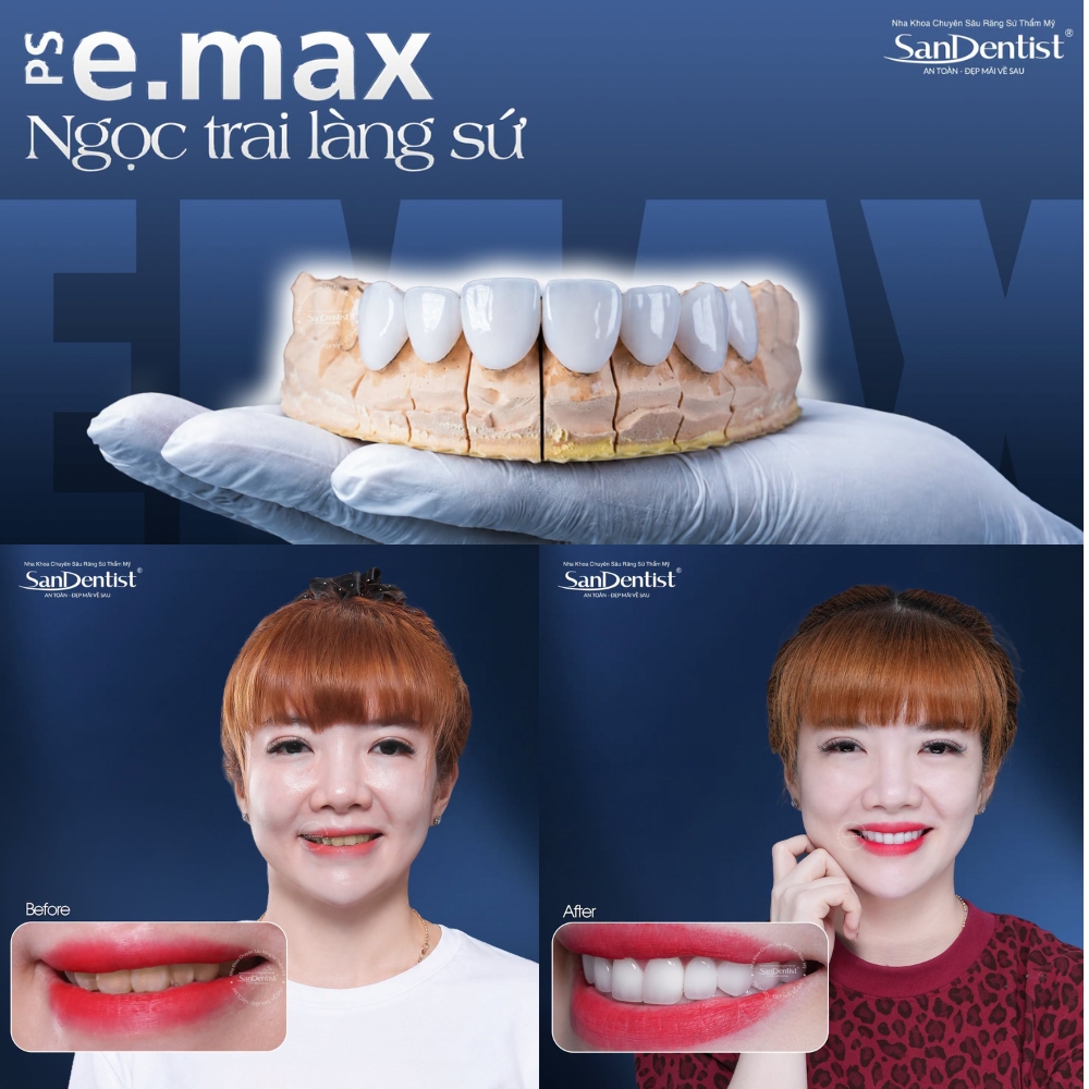 dán sứ veneer là gì - hình 4