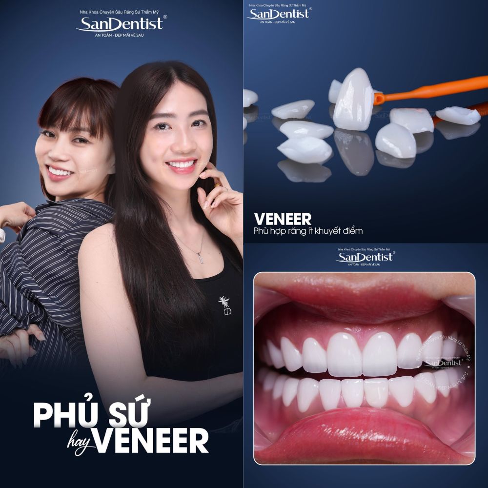Dán sứ Veneer là gì: template A-Z 2026