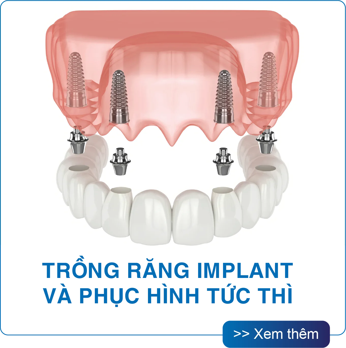Trồng răng Implant và phục hình tức thì tại San Dentist