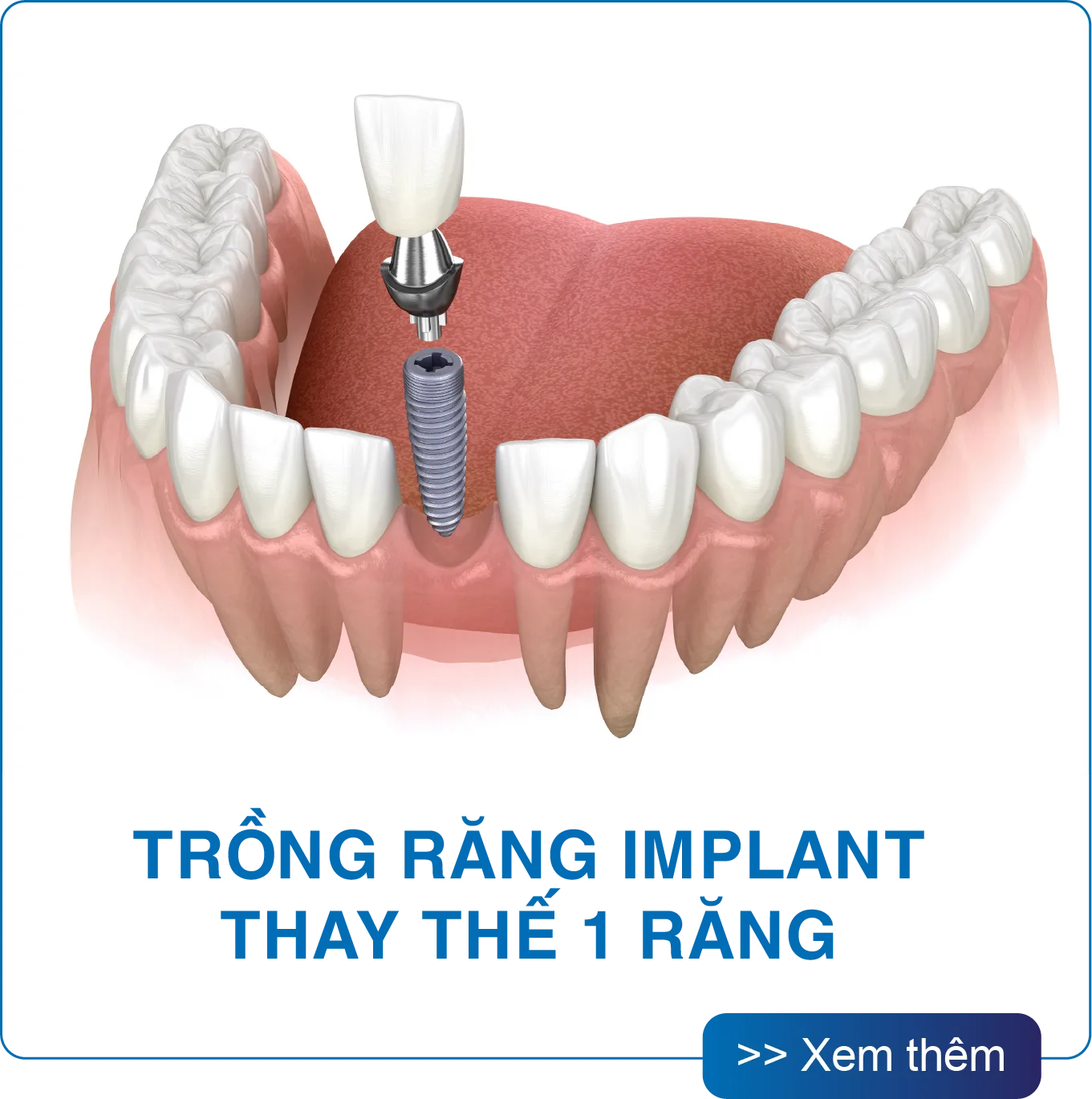Trồng răng Implant thay thế một răng tại San Dentist