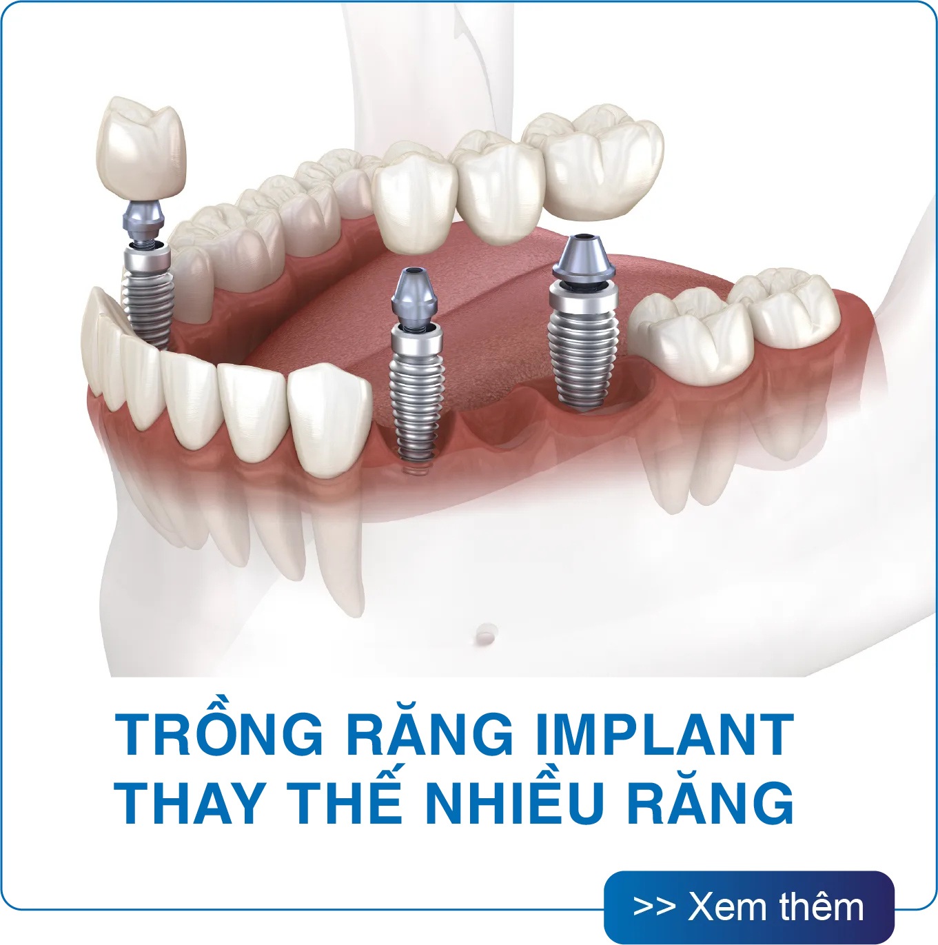 Trồng răng Implant thay thế một vài răng tại San Dentist