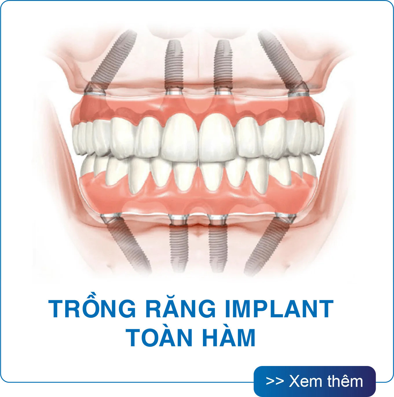 Trồng răng Implant toàn hàm tại San Dentist