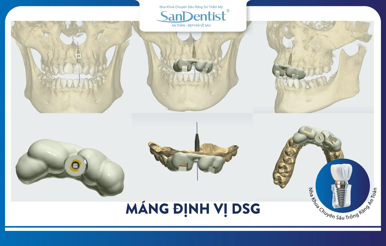 DSG surgical guide is used in the dental implant procedure at San Dentist