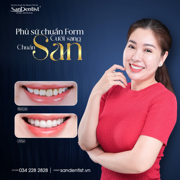 Phủ sứ vs bọc sứ khác gì nhau: so sánh 2026