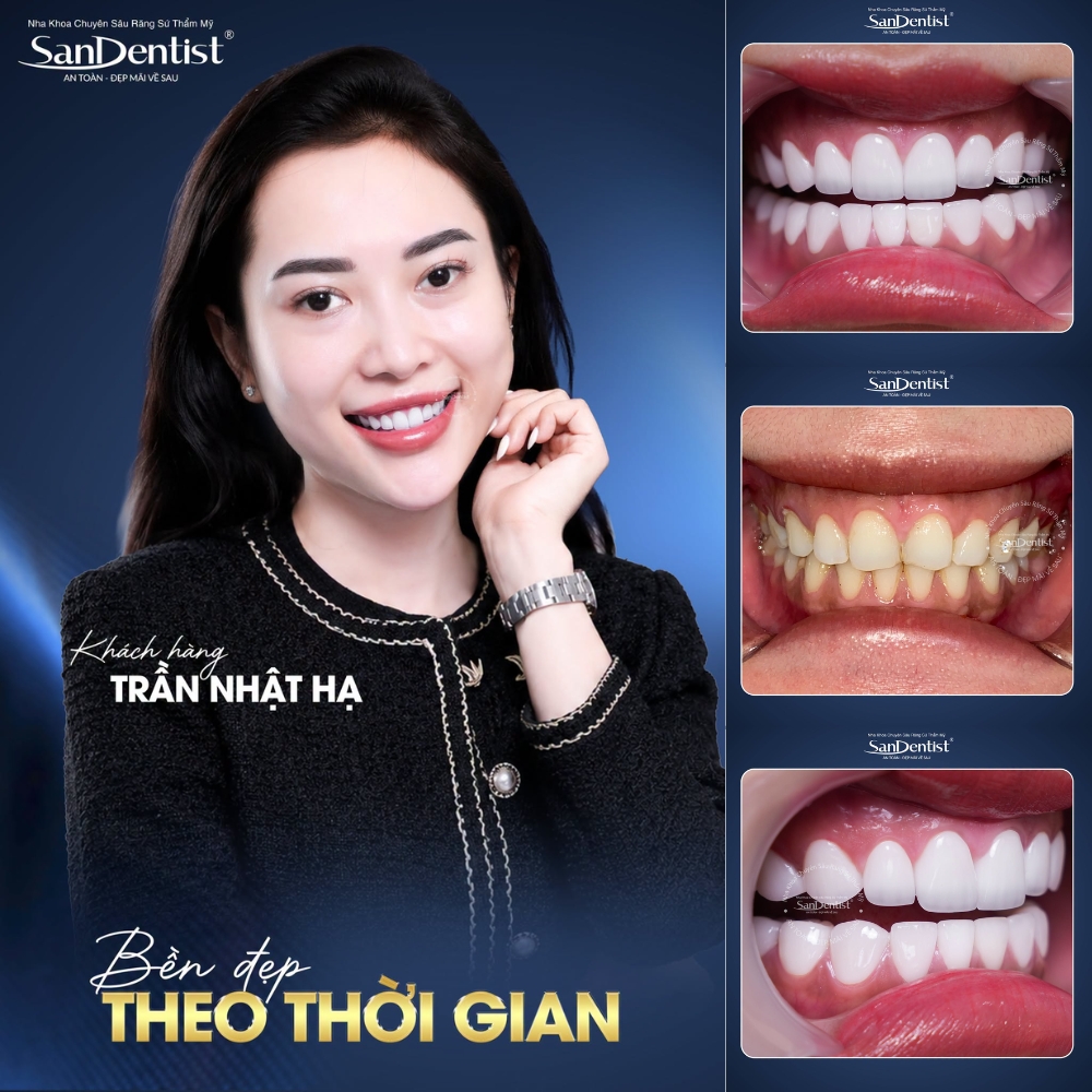 phủ sứ vs bọc sứ - hình 4