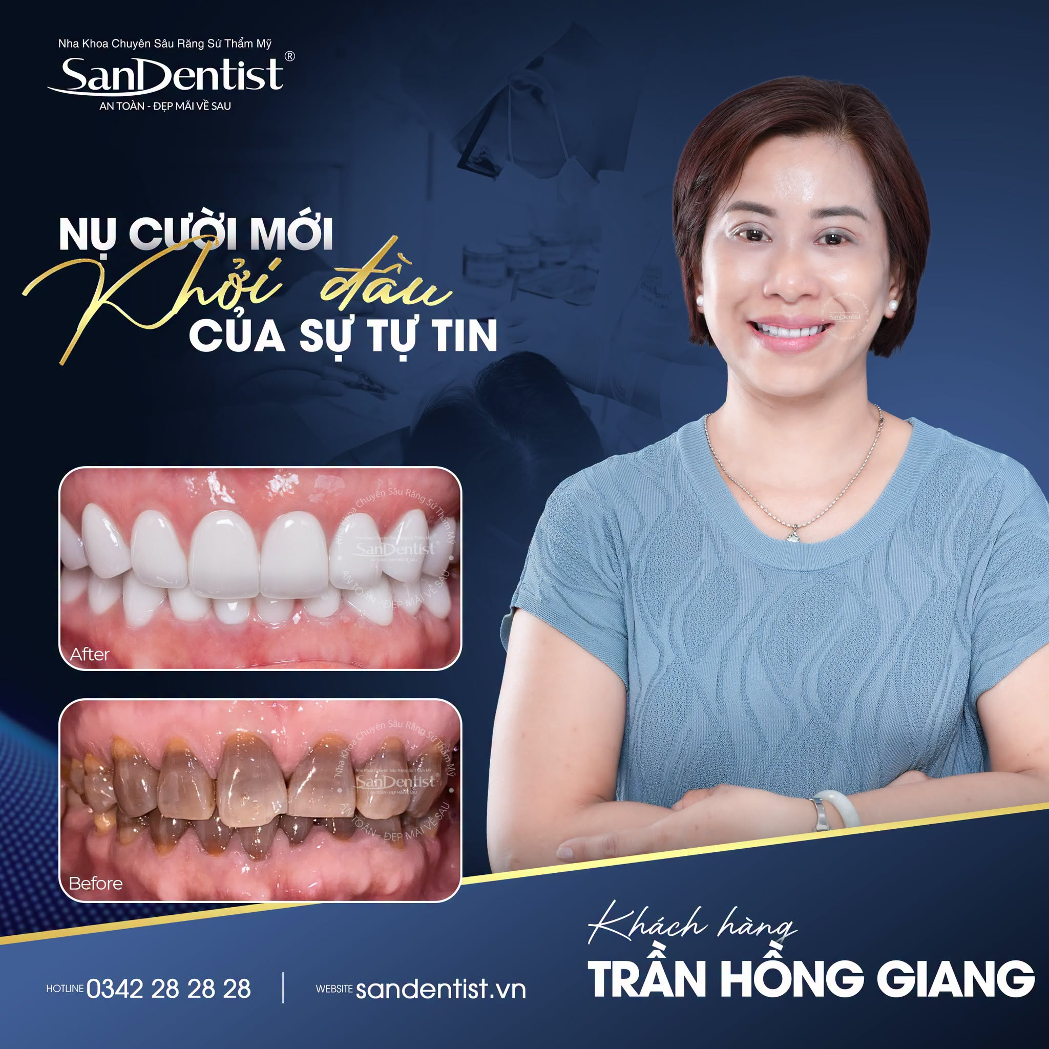 phủ sứ vs bọc sứ - hình 5